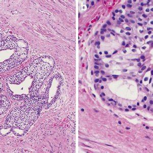 inflammation glande de skene|Skenes gland